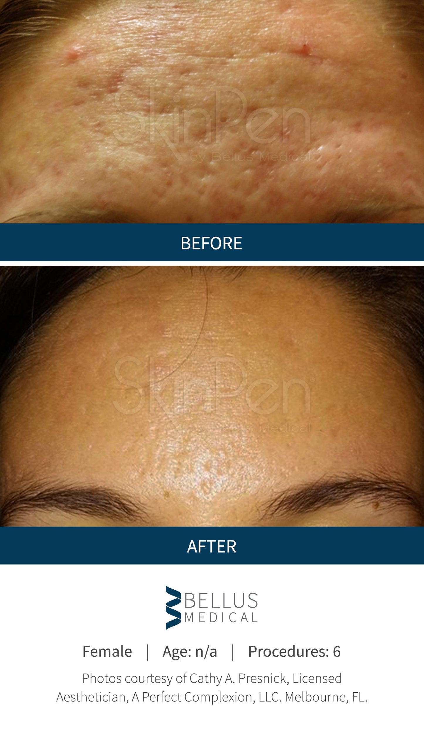 Microneedling: 5 + 1 gratis